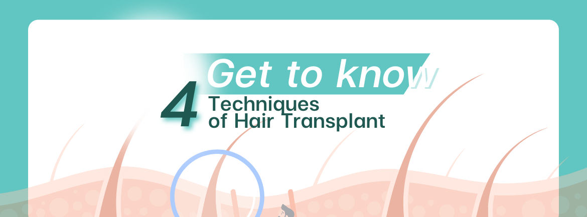 4 Techniques of Hair Transplant