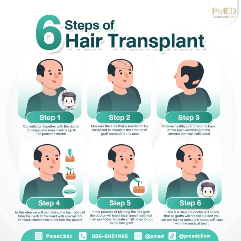 6ขั้นตอนปลูกผม Eng PMED