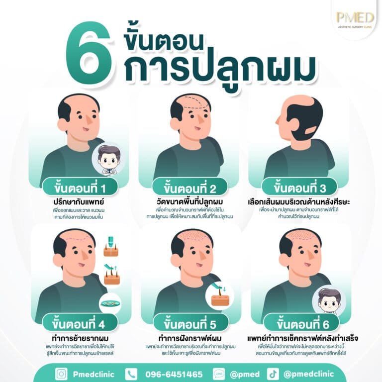 6ขั้นตอนปลูกผม TH PMED