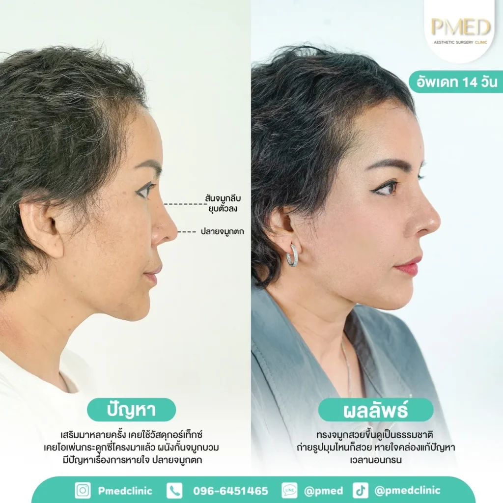 เสริมจมูกในผู้สูงอายุแบบปลอดภัย ควรรู้ก่อนตัดสินใจ 3 เสริมจมูกในผู้สูงอายุแบบปลอดภัย ควรรู้ก่อนตัดสินใจ