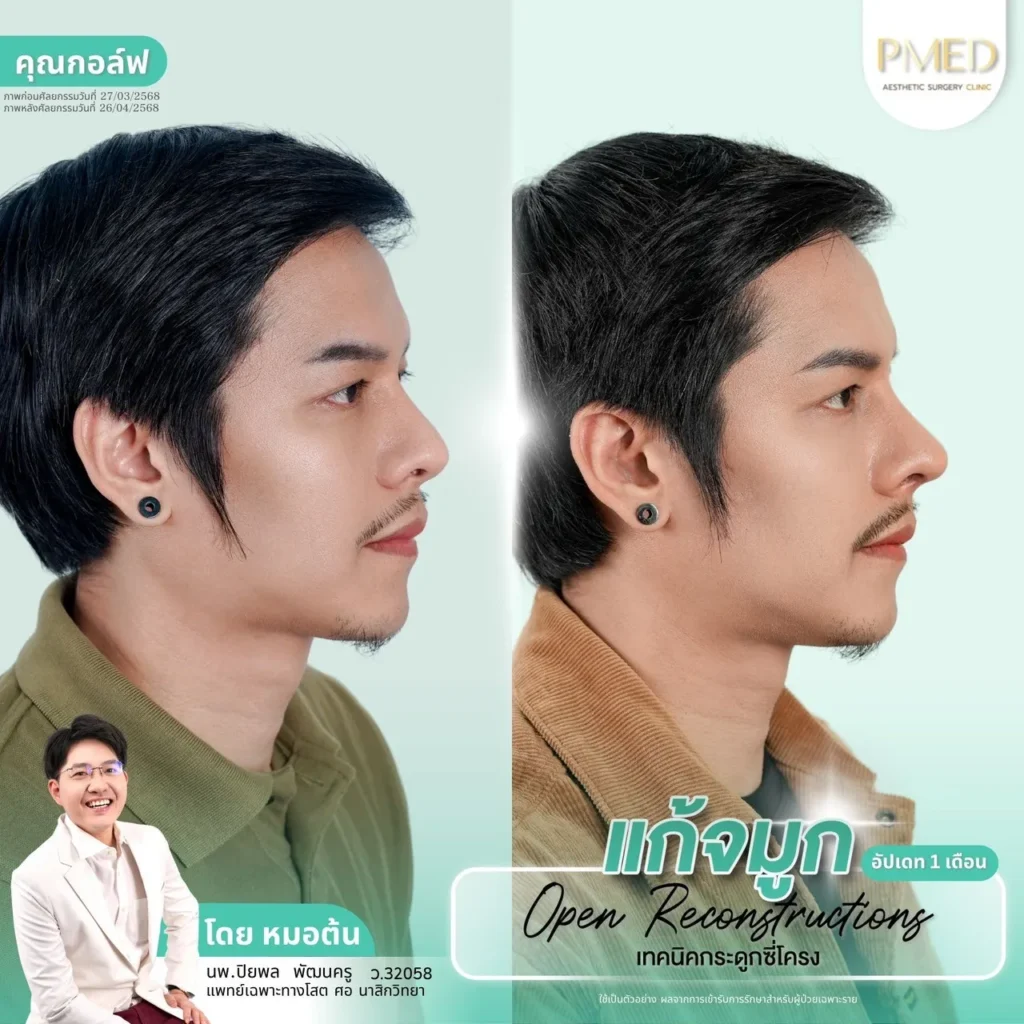 การเสริมจมูกแบบโอเพ่นคืออะไร? รวมทุกข้อที่ควรรู้ พร้อมข้อดีข้อเสีย