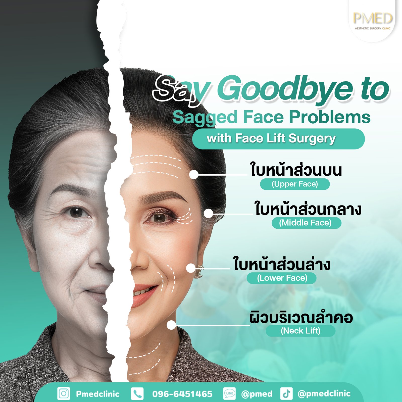 บอกลาปัญหาหย่อนคล้อย ENG PMED