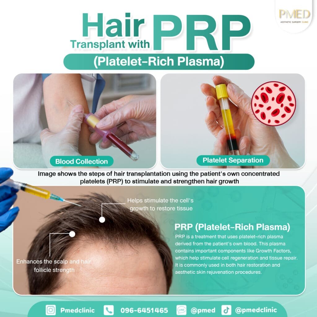 ปลูกผมและวิธี ENG PMED
