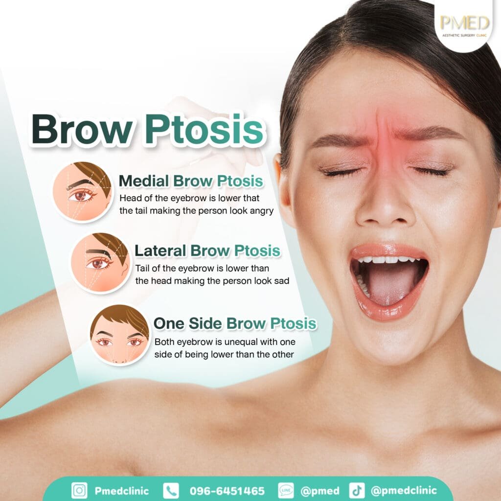 ภาวะคิ้วตก ENG PMED