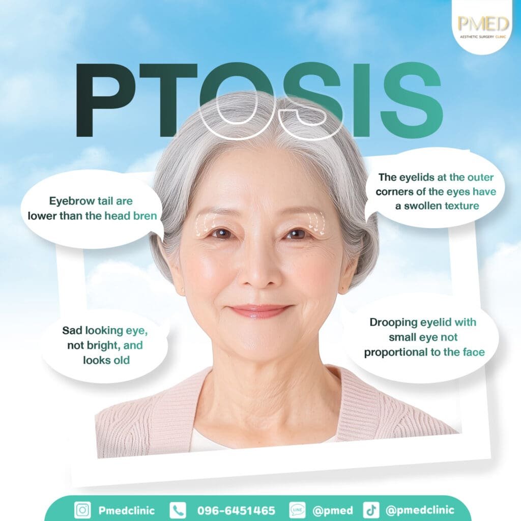 ภาวะหางตาตก ENG PMED