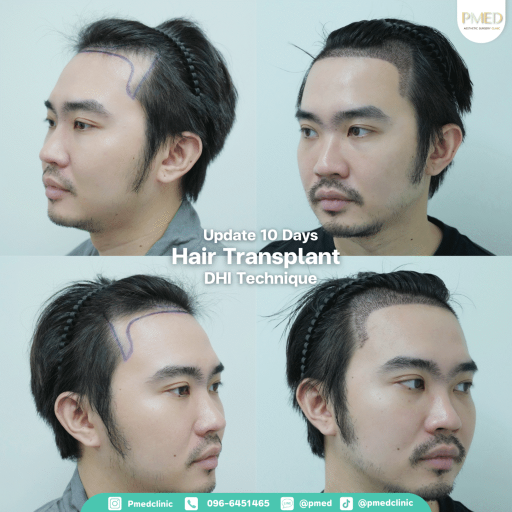 รีวิวปลูกผมpmed42G 1