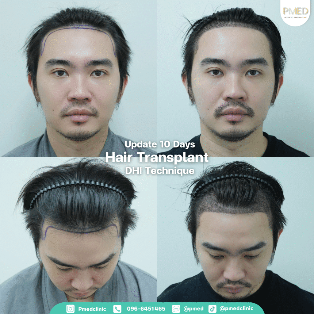 รีวิวปลูกผมpmed42G