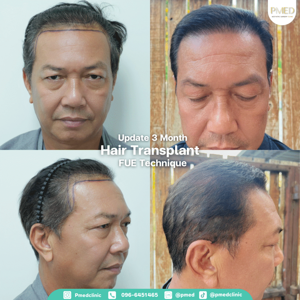 รีวิวปลูกผมpmed42G 2
