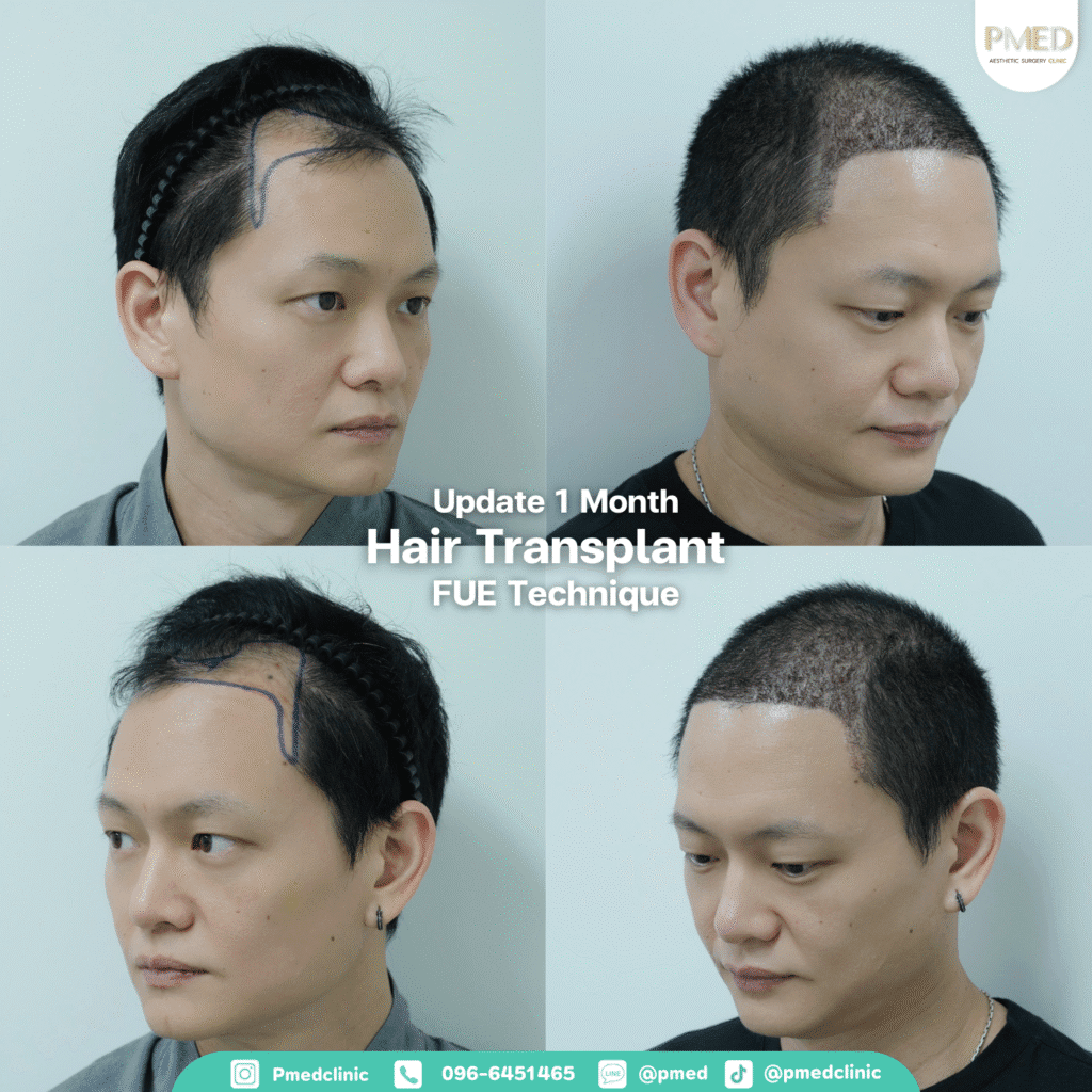 รีวิวปลูกผมpmed42G 3