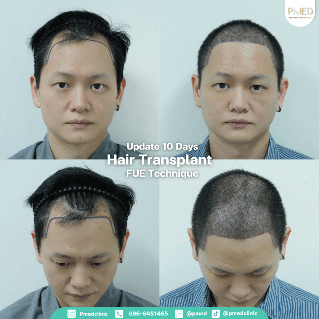 รีวิวปลูกผมpmed42G 4