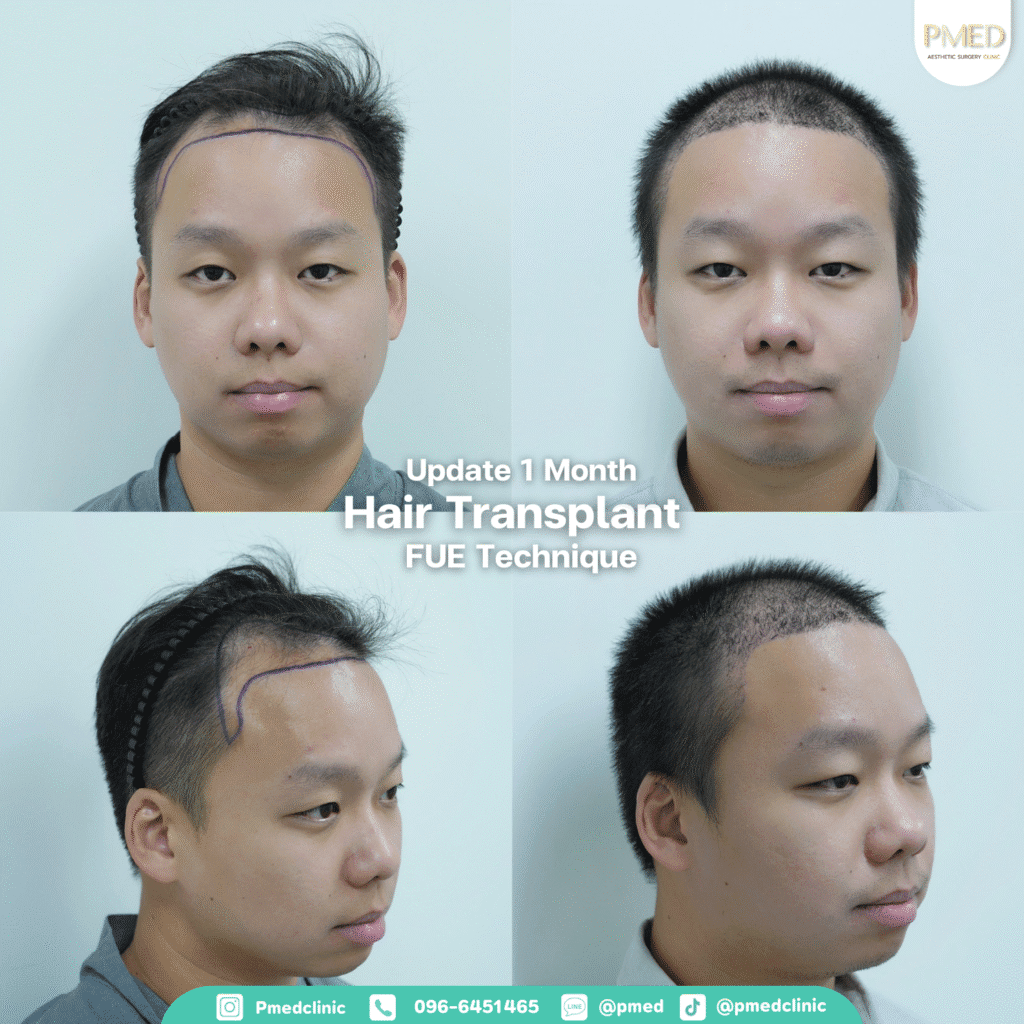 รีวิวปลูกผมpmed42G 5