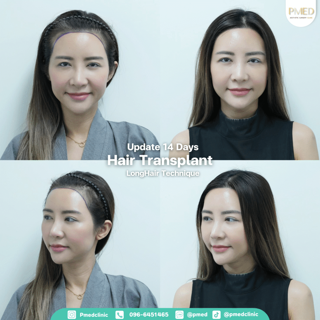 รีวิวปลูกผมpmed42G 6