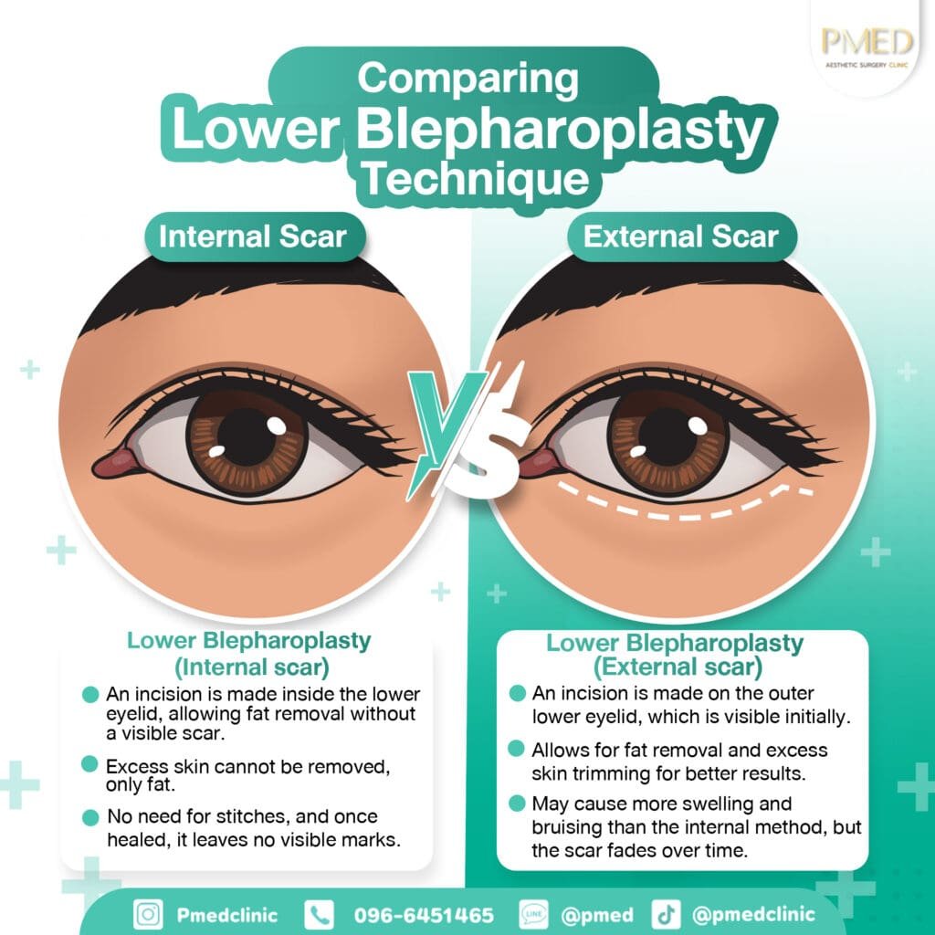 เปรียบเทียบใต้ตา ENG PMED