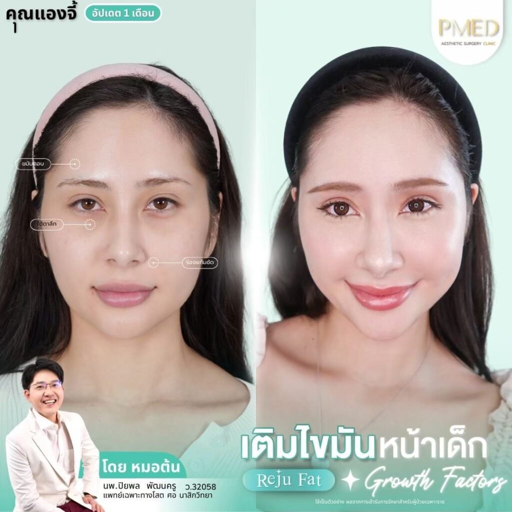 LINE ALBUM เติมไขมัน Reju Fat ✨ 260326 10