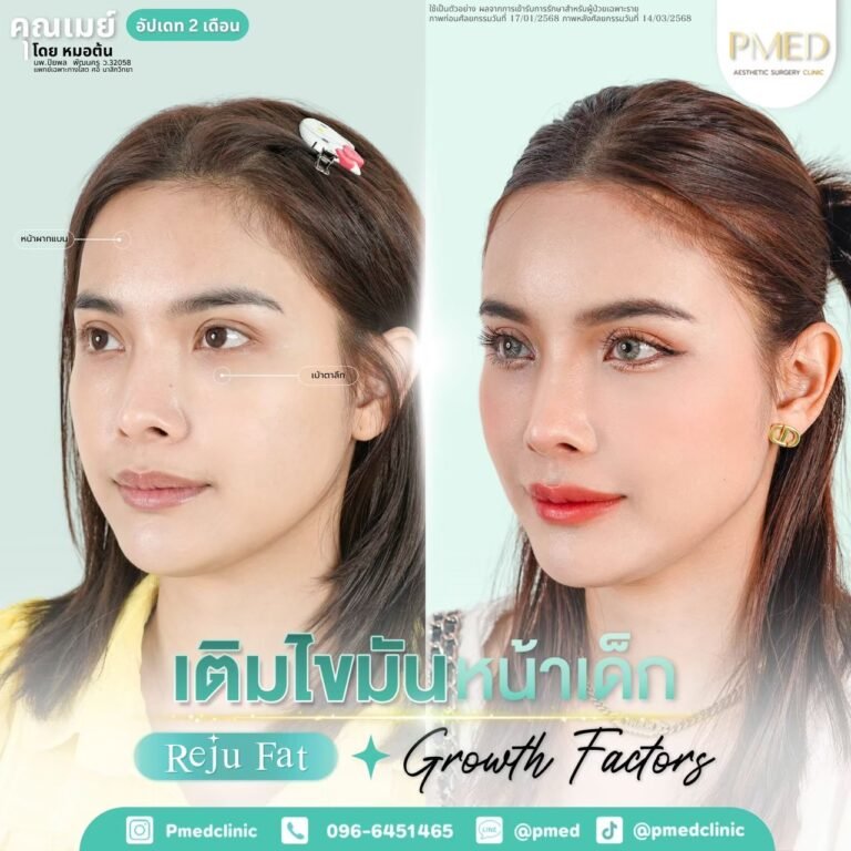 เติมไขมัน Reju Fat ภาพที่ 16 — เติมไขมันหน้า PMED Clinic หมอต้น