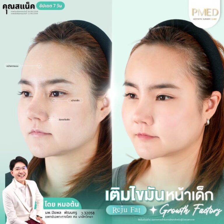 เติมไขมัน Reju Fat ภาพที่ 17 — เติมไขมันหน้า PMED Clinic หมอต้น