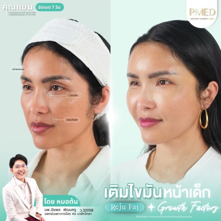 เติมไขมัน Reju Fat ภาพที่ 18 — เติมไขมันหน้า PMED Clinic หมอต้น