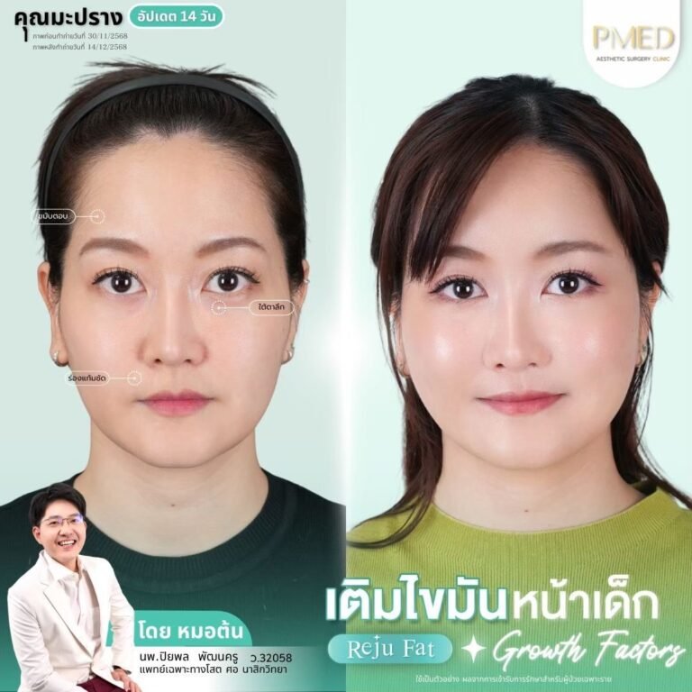 เติมไขมัน Reju Fat ภาพที่ 5 — เติมไขมันหน้า PMED Clinic หมอต้น