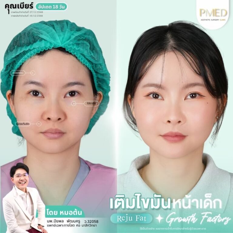 เติมไขมัน Reju Fat ภาพที่ 7 — เติมไขมันหน้า PMED Clinic หมอต้น