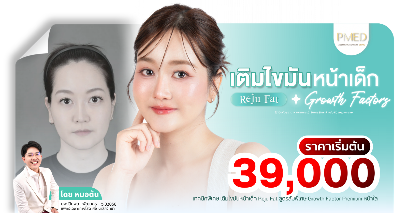 เติมไขมันหน้า ราคาเริ่มต้น 39,000 บาท