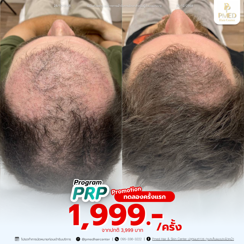 รีวิวPRP 6