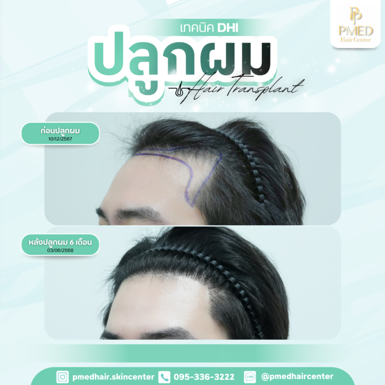 เทคนิค DHI (1)