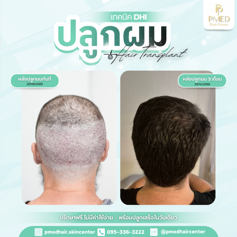 เทคนิค DHI (13)