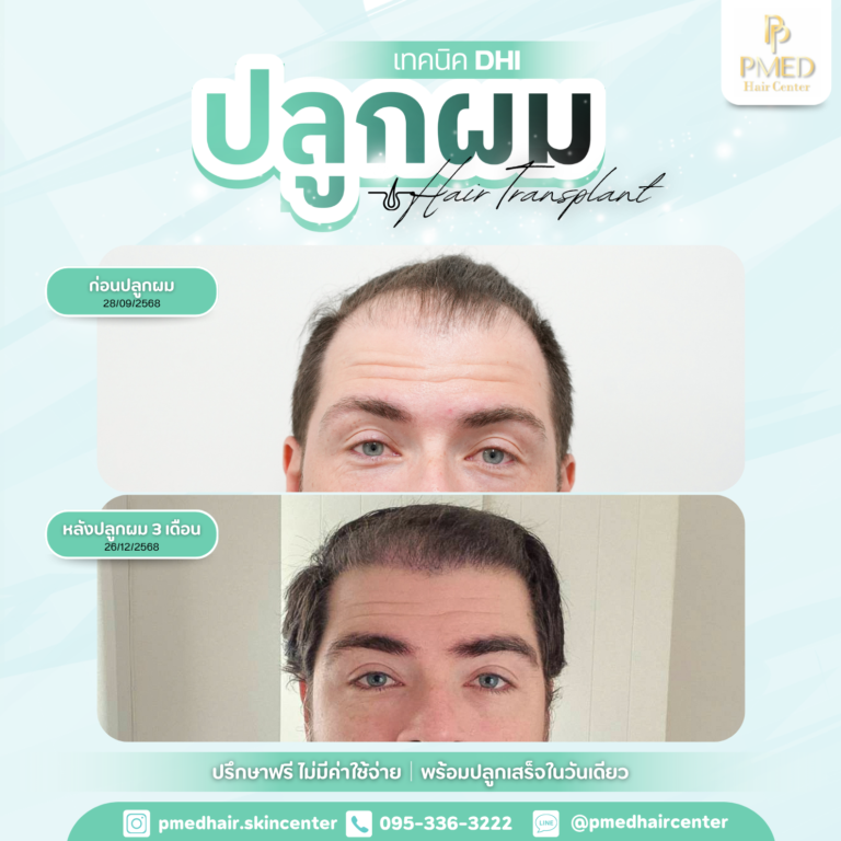 เทคนิค DHI (15)