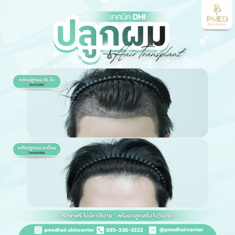 เทคนิค DHI (2)