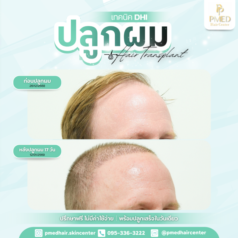 เทคนิค DHI (21)