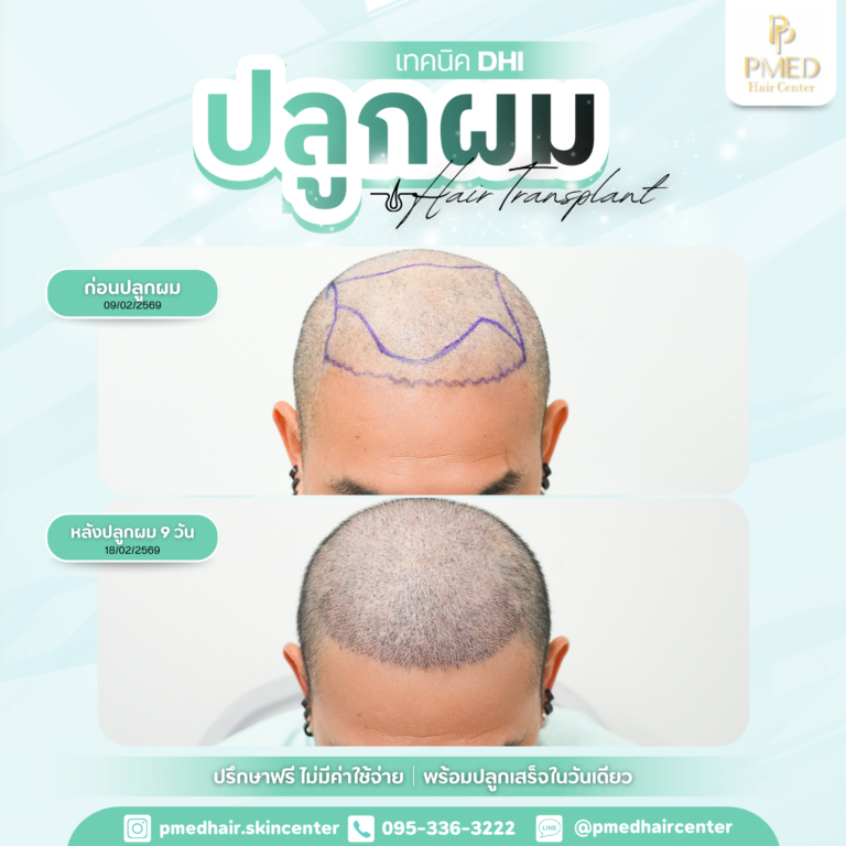 เทคนิค DHI (23)