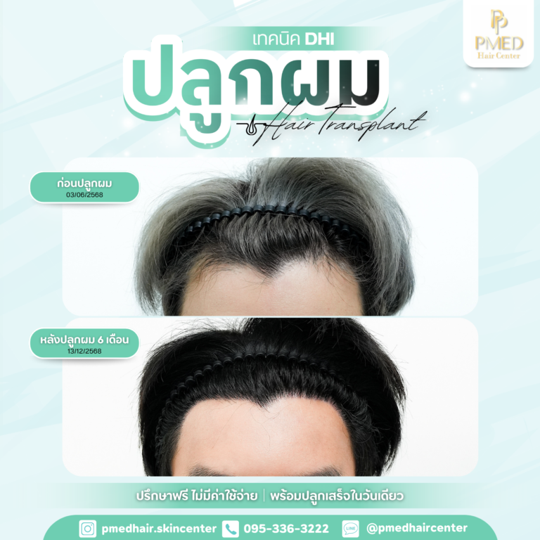 เทคนิค DHI (4)