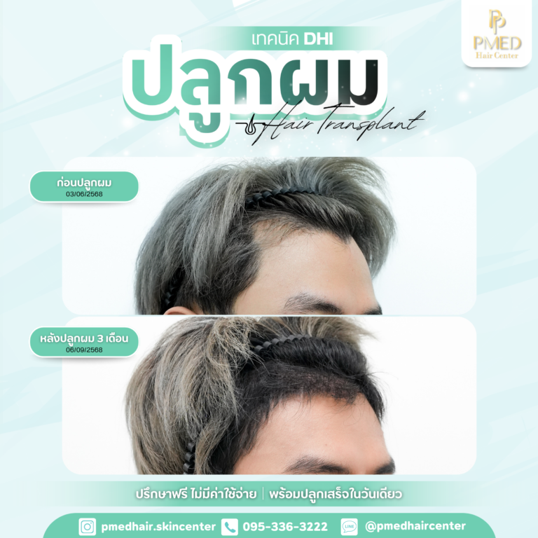 เทคนิค DHI (5)