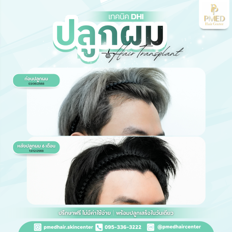 เทคนิค DHI (6)