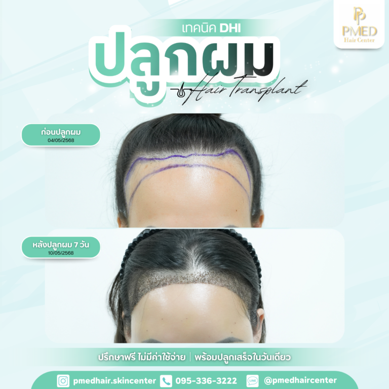 เทคนิค DHI (8)