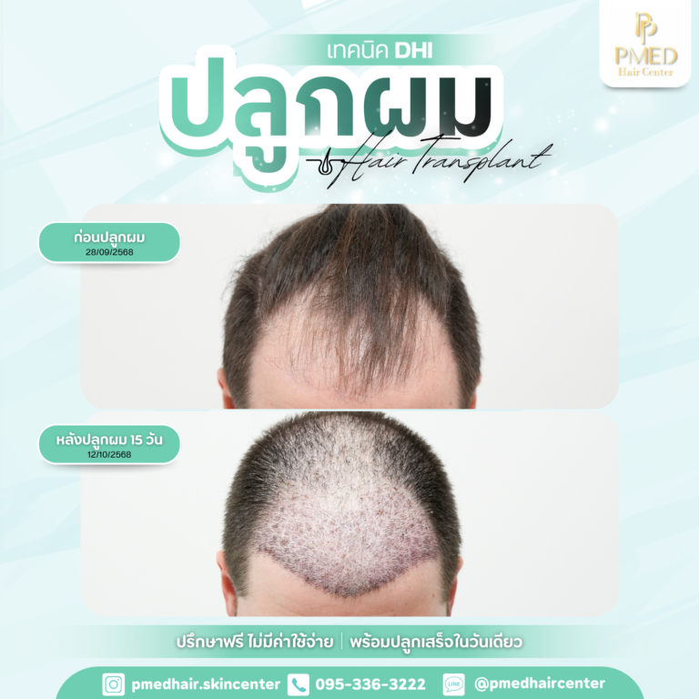 เทคนิค DHI (9)