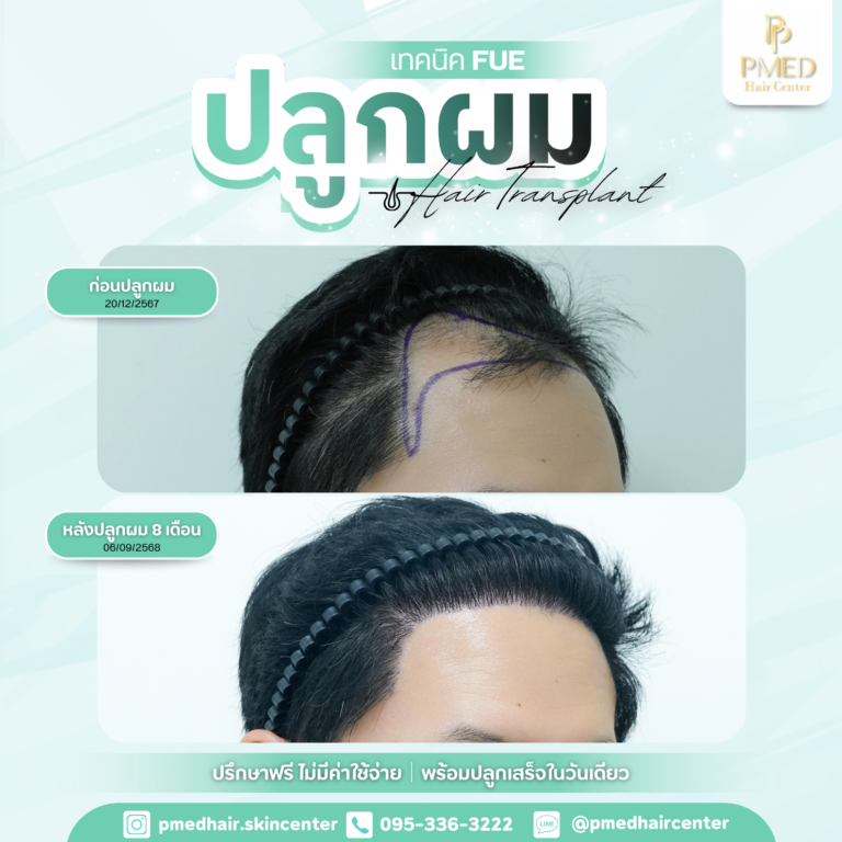 เทคนิค FUE (1)