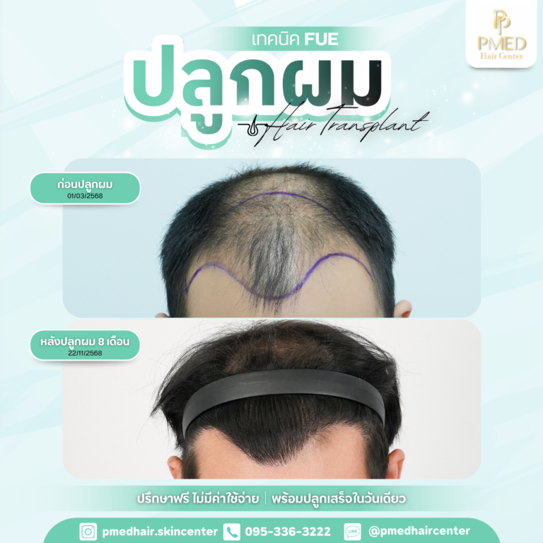 เทคนิค FUE (11)