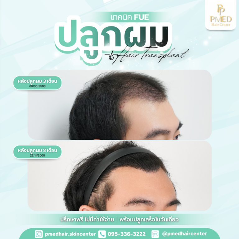 เทคนิค FUE (12)