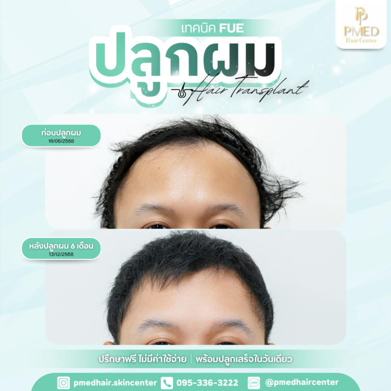 เทคนิค FUE (14)