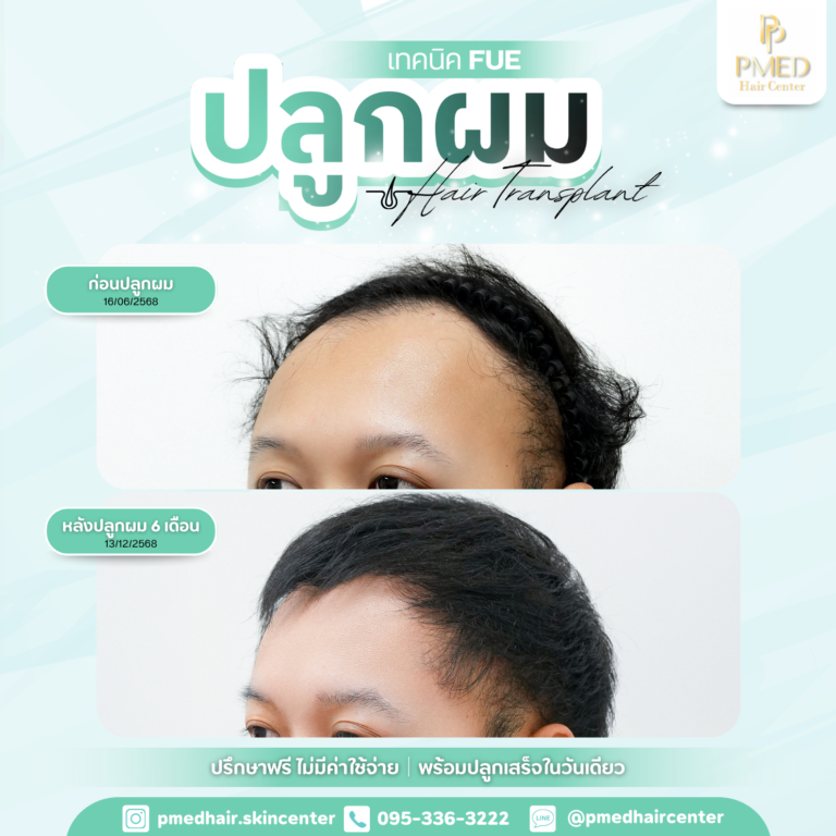 เทคนิค FUE (15)