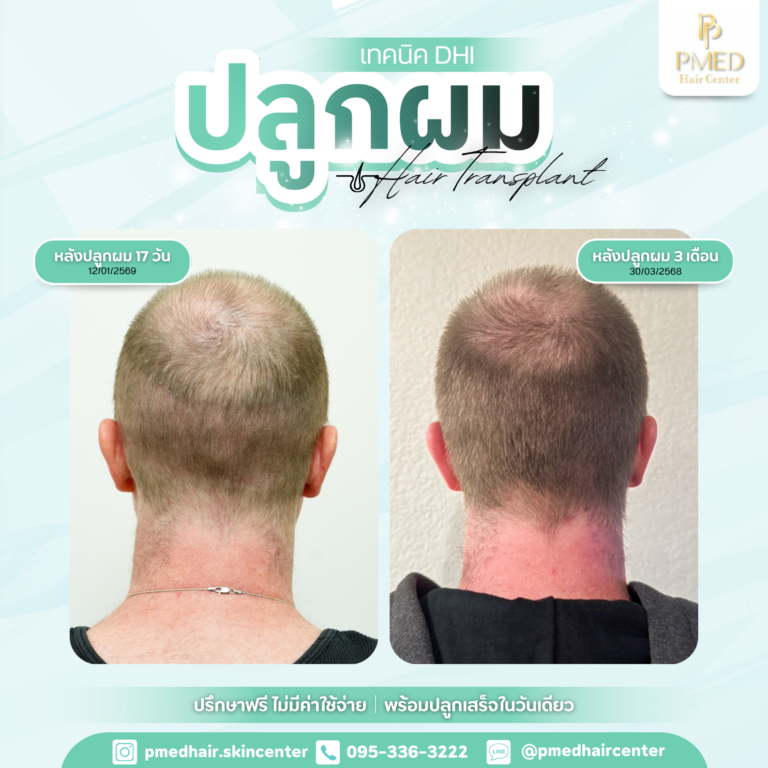 เทคนิค FUE (16)