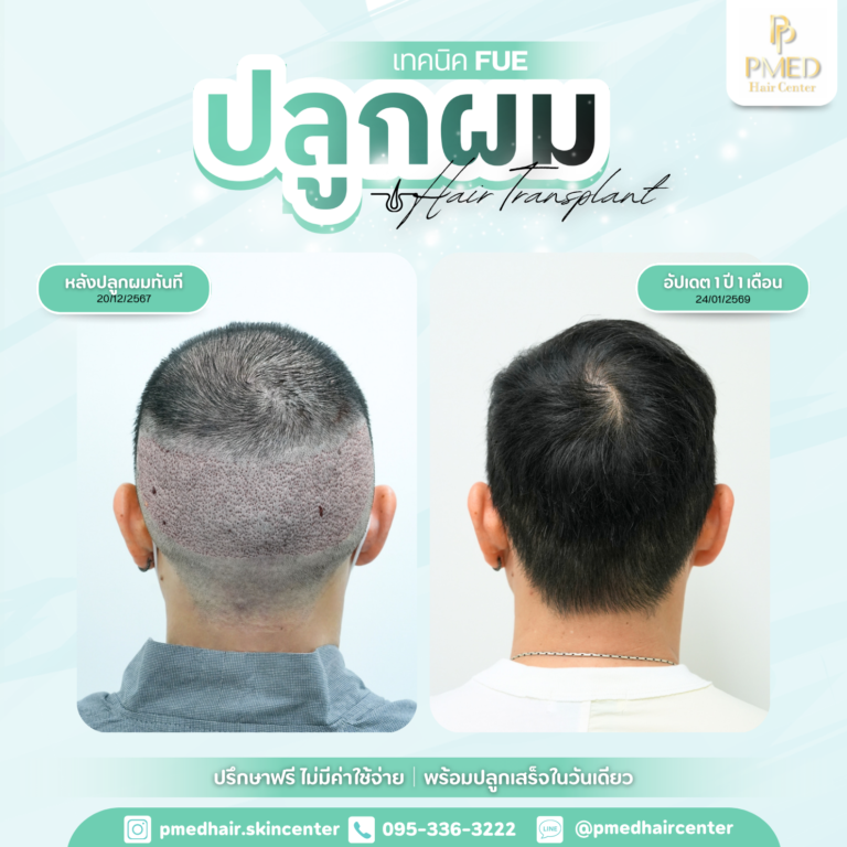 เทคนิค FUE (2)
