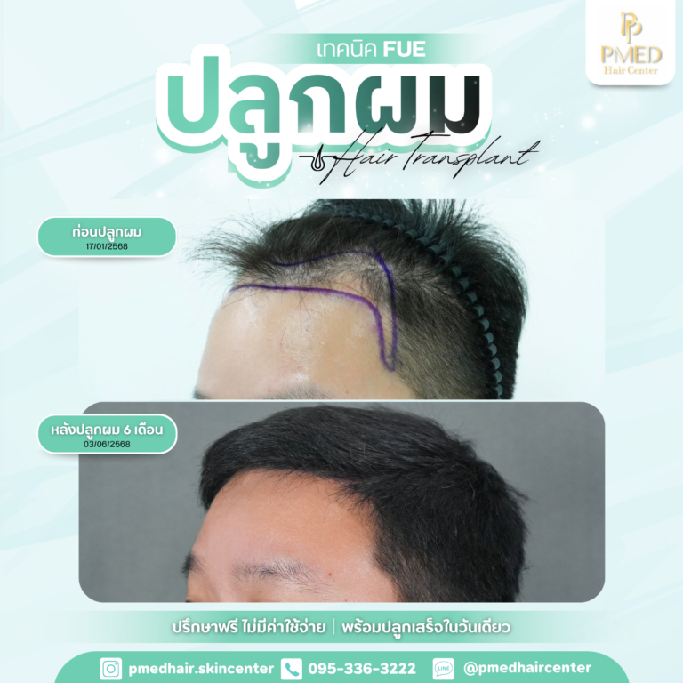 เทคนิค FUE (3)