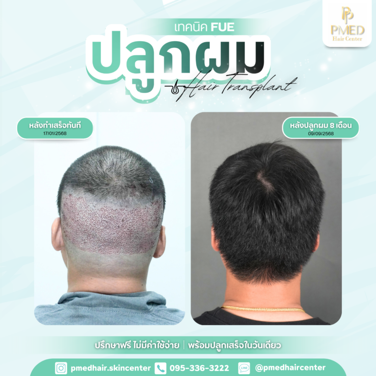เทคนิค FUE (6)