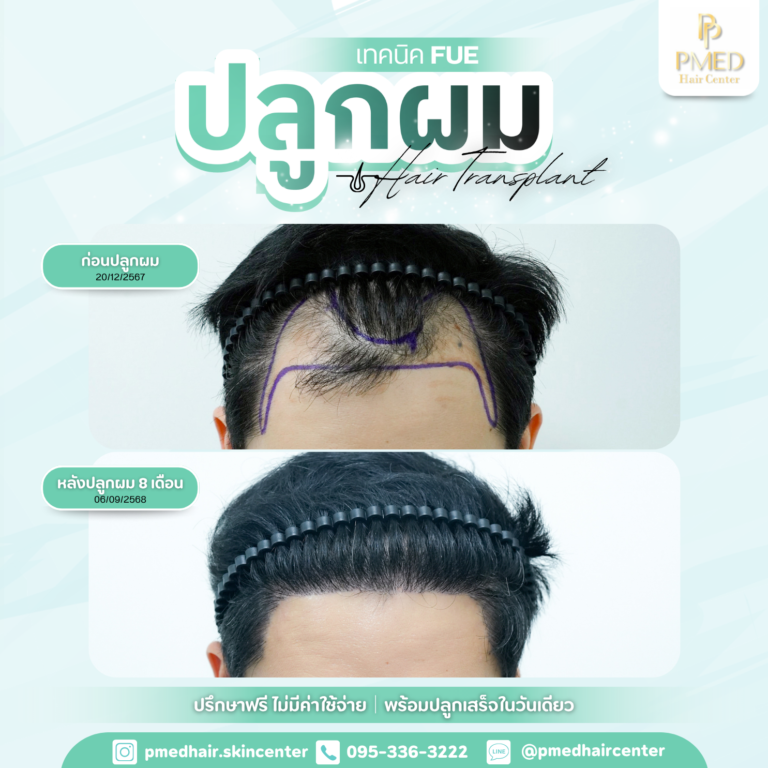 เทคนิค FUE