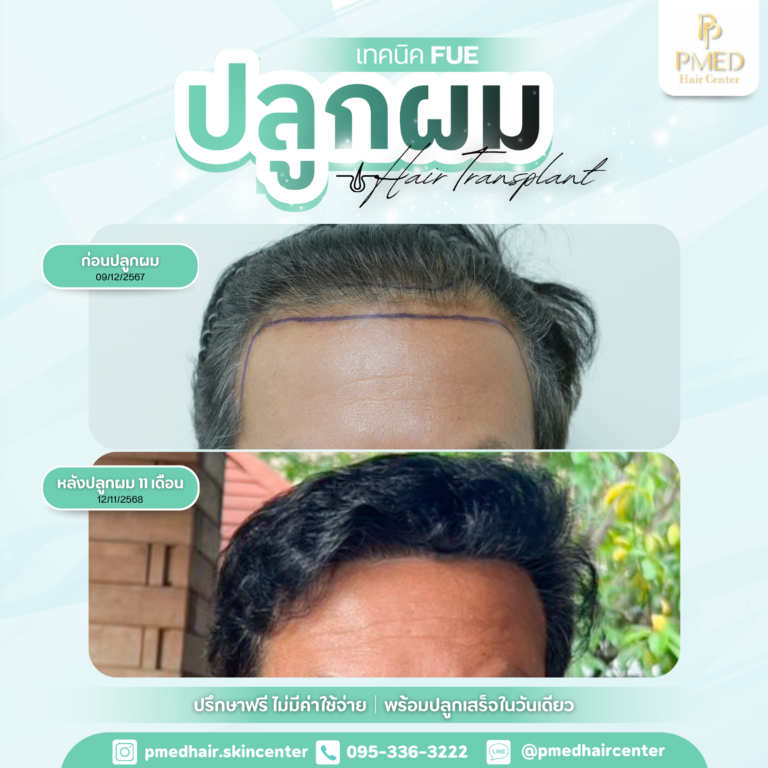 เทคนิค FUE (8)