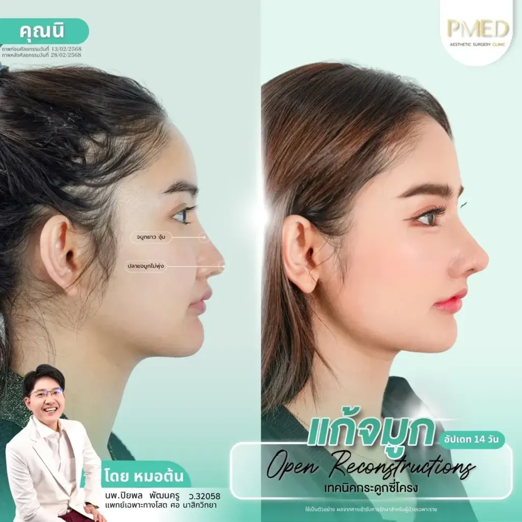 rib-cartilage-000025