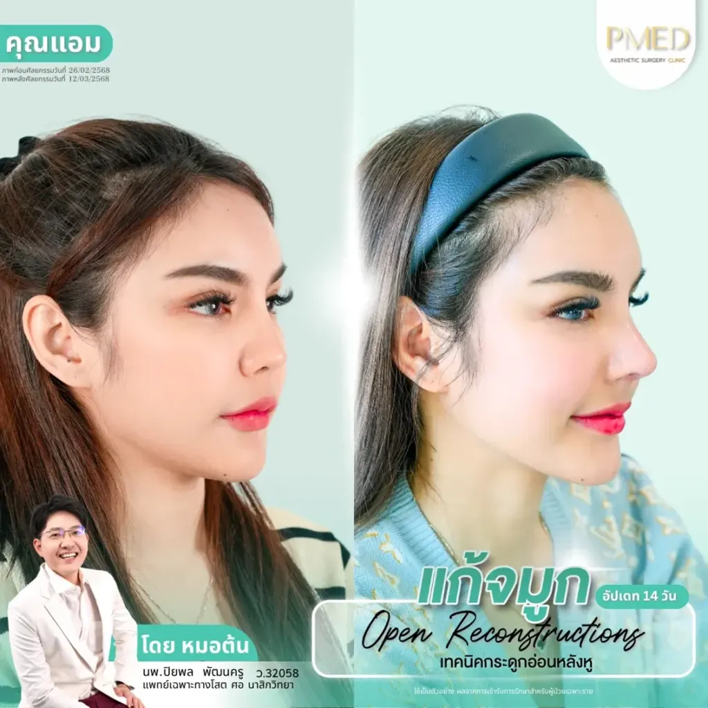 rib-cartilage-000039