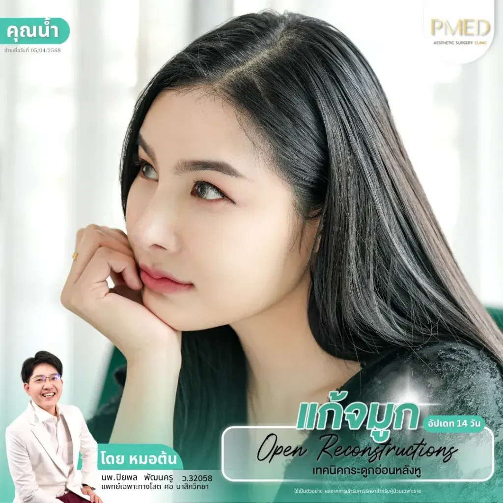 rib-cartilage-000042